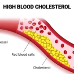 Increased Cholesterol : कोलेस्ट्रॉल बढ़ने के क्या है कारण ? जाने कम करने के उपाए