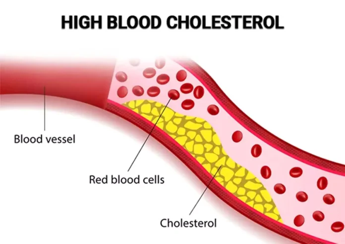 Increased Cholesterol : कोलेस्ट्रॉल बढ़ने के क्या है कारण ? जाने कम करने के उपाए