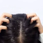 Dandruff Problem : क्या है डैंड्रफ से बचें के उपाये आइये जाने