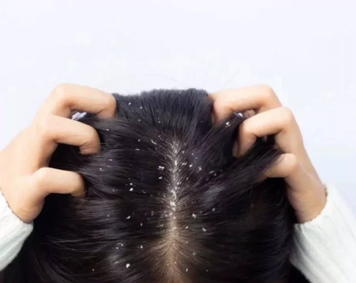 Dandruff Problem : क्या है डैंड्रफ से बचें के उपाये आइये जाने